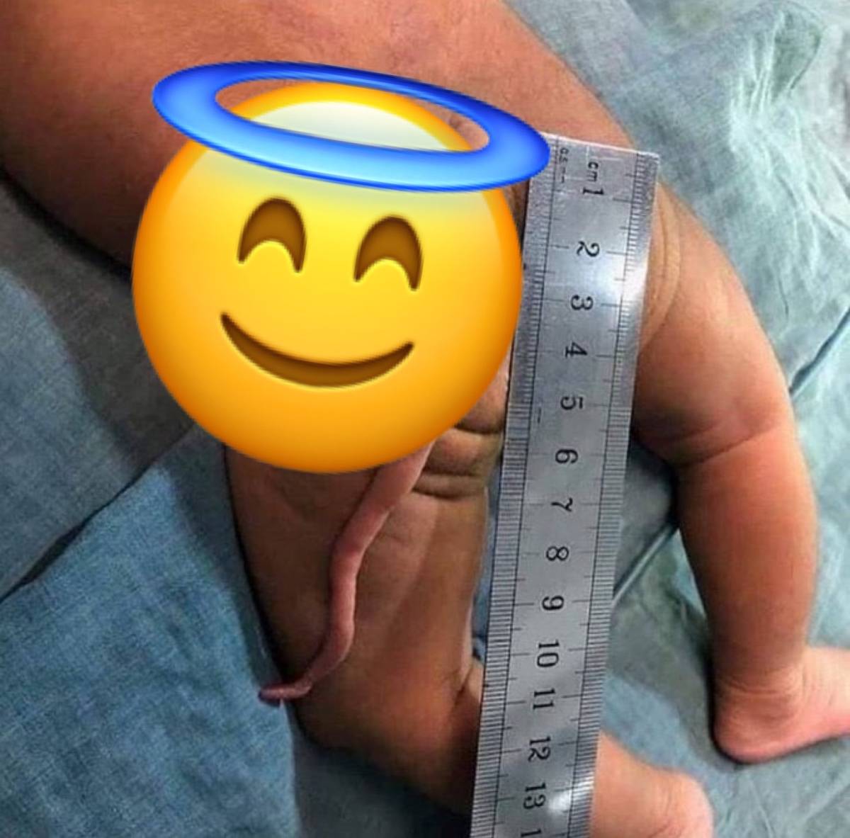 Newborn Born With 11cm Skin-Covered Appendage Above Lower Back โ Could this be a human tail?๐ค