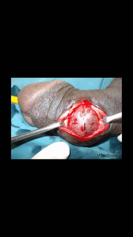 Your penis has no bone, but it can “break” during erection.
When hard, it is filled with blood. Su...