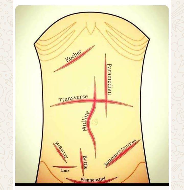 Understanding different surgical incisions