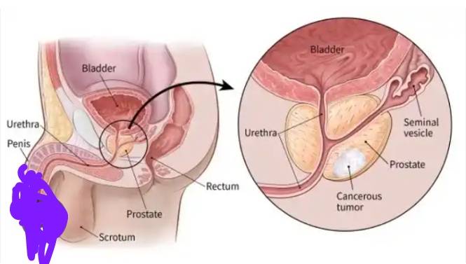 What Is Prostate Cancer?
A tumor forming inside the prostate gland
Most prostate cancers grow slowly...