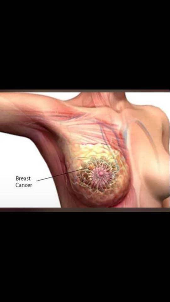 Dear All,
Please If you know of any lady battling BREAST CANCER of whatever stage please advise her...
