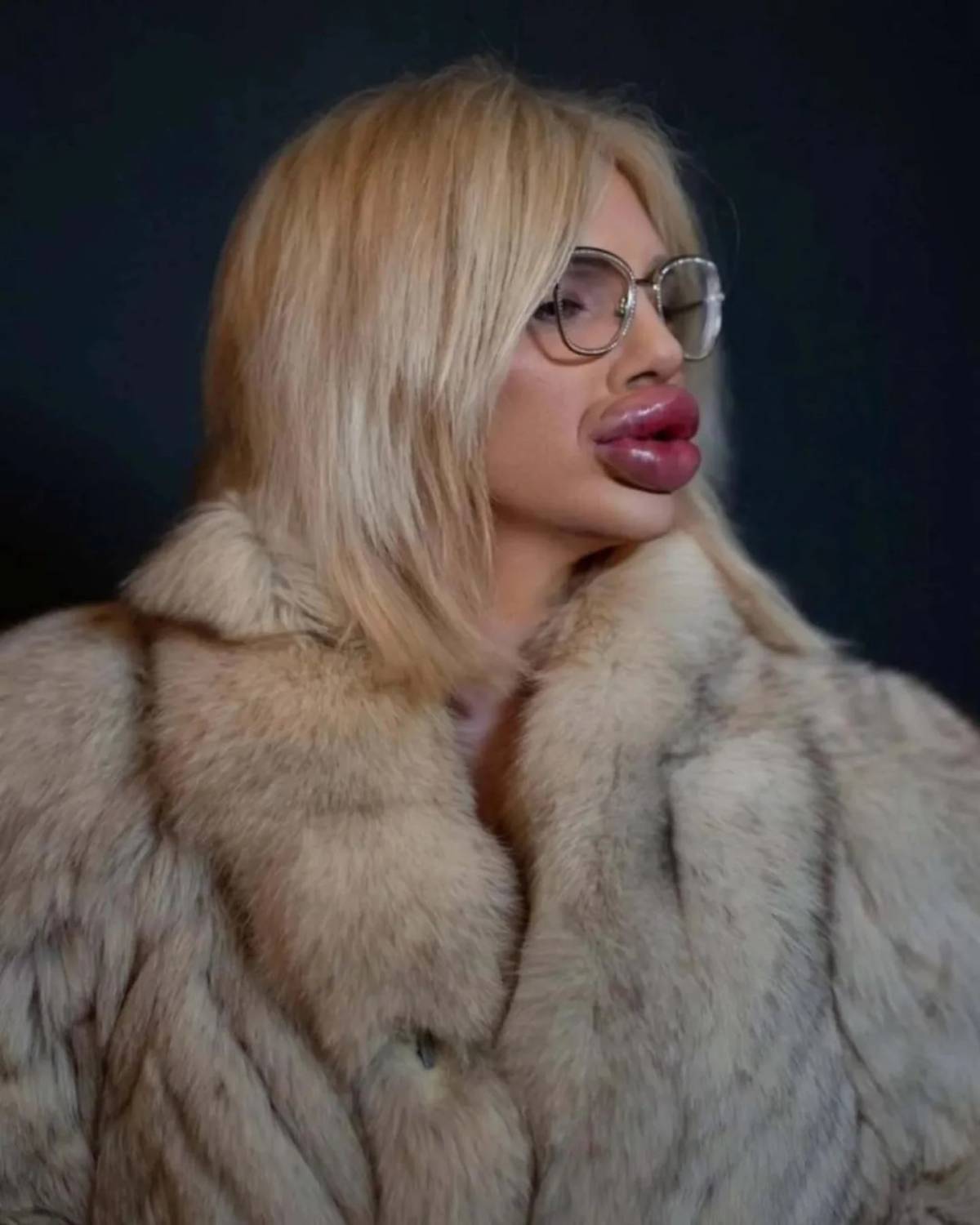 Influencer Vienna Würstel who spent $49,000 on lip fillers chasing the "world's biggest lips" crown...