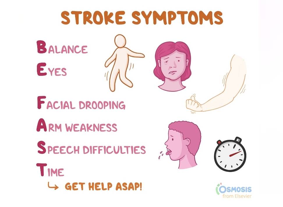 Do you know the signs of stroke and what to do?
Immediately, call for help. Do not wait to see if s...