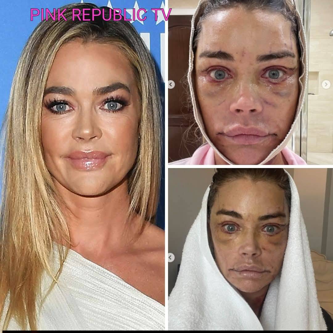 https://pinkrepublic12.blogspot.com/2026/03/denise-richards-discusses-her-face-lift.html?m=1
