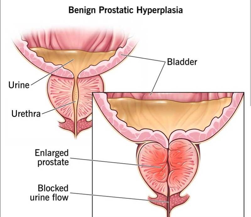 When the Prostate Is Enlarged: What Every Man Should Know
An enlarged prostate—medically called Ben...