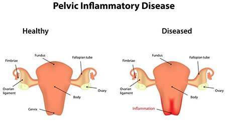 Pelvic Inflammatory Disease (PID)`
Pelvic Inflammatory Disease (PID) is a serious but often prevent...
