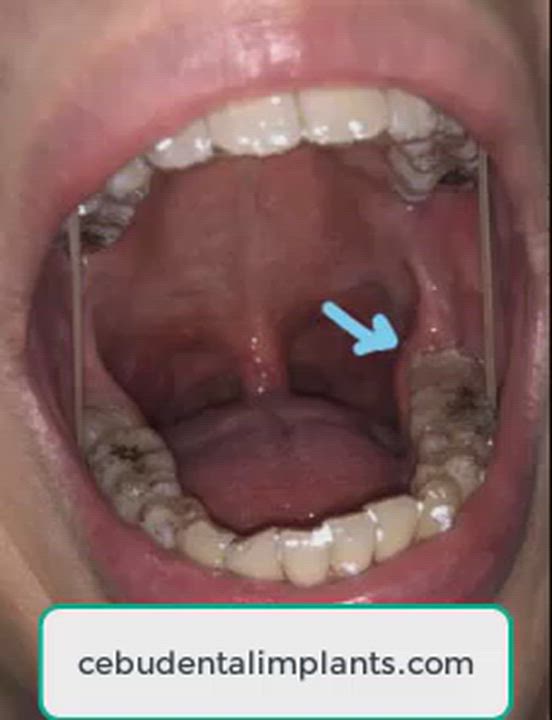 Real Teeth Problems: Crooked Teeth, Missing Teeth & Bone Loss (See the Signs) : Missing teeth don’t...