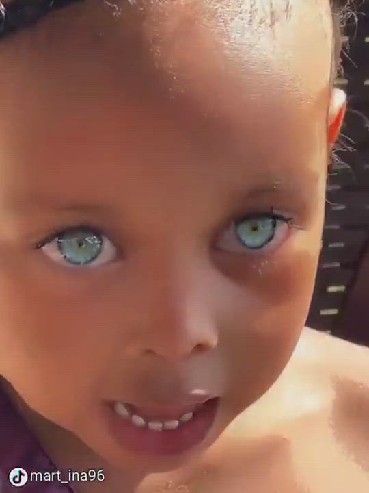 Blue eyes in Black individuals often stem from Waardenburg syndrome, a genetic mutation disrupting m...