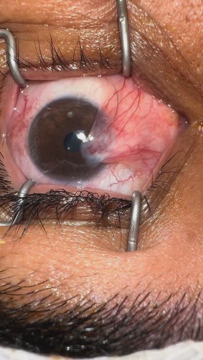 pterygium excision