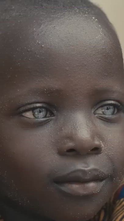 Blue eyes in individuals of African descent are extremely rare, occurring due to recessive OCA2 gene...