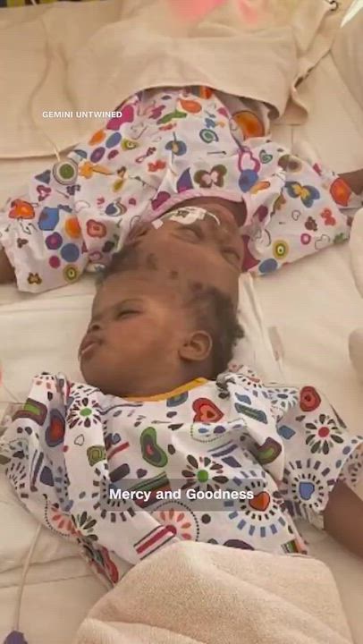 Wow 👏👏🙌🏾

These Nigerian conjoined twins were successfully separated after complex skull-fusion...